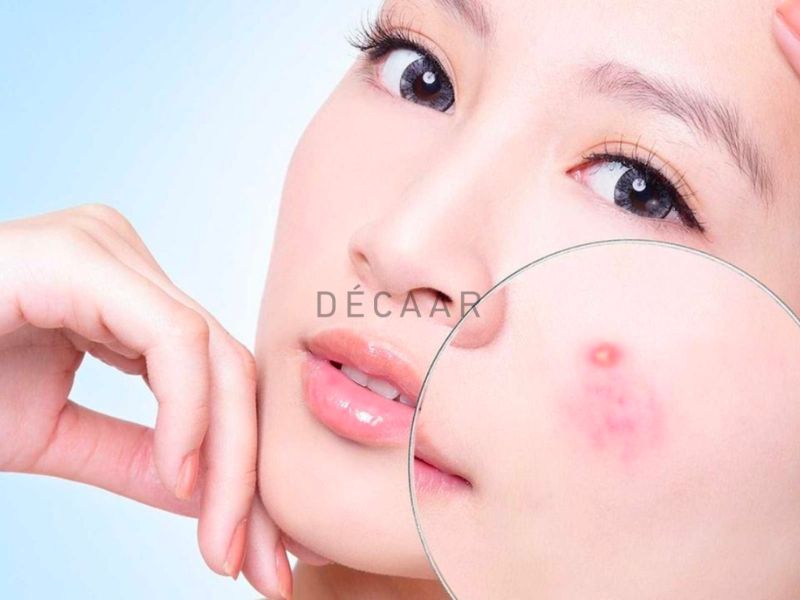 trị mụn trứng cá bọc nhanh nhất